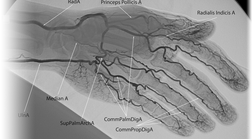 КТ-ангиография артерий верхних конечностей