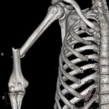 Оскольчатый перелом ср/3 диафиза правой плечевой кости со смещением