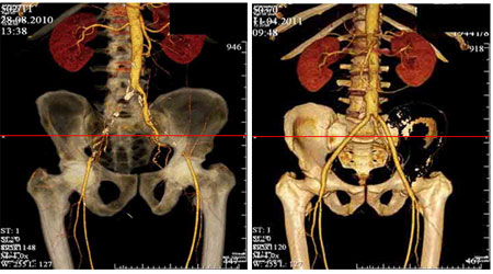 КТ-ангиография почечных артерий
